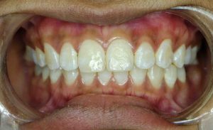 FLUOROSIS