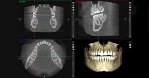 CBCT.